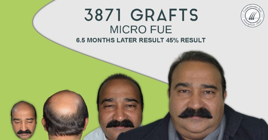 4000 grafts results in Pakistan