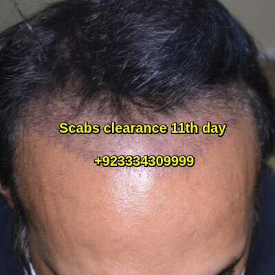 Scabs clearance after hair transplant