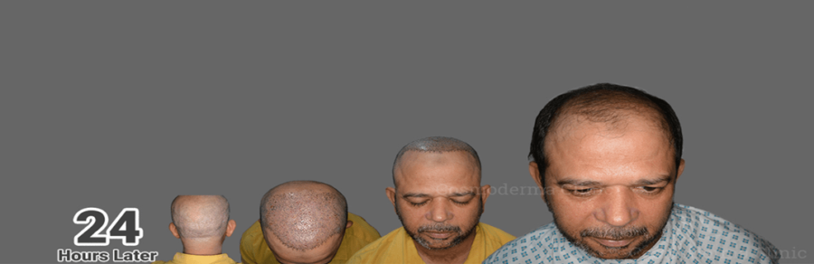 3000 grafts Fue procedure in Pakistan