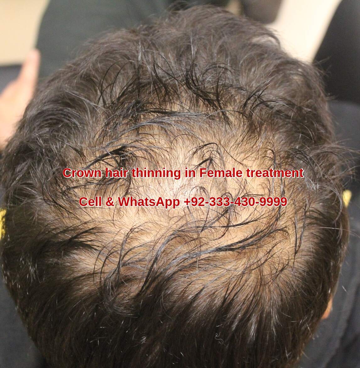 female hair thinning
