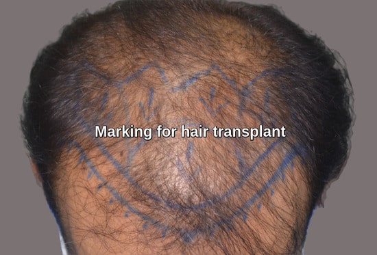 Baldness treatment marking Saudi Arabia patient