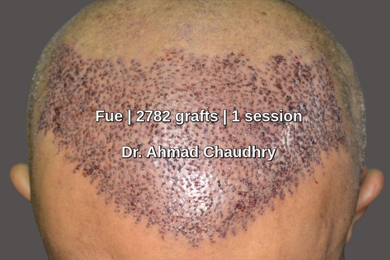 Front view hair transplant Riyadh Saudi Arabia patient