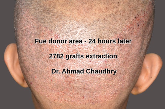 Fue donor area 2782 grafts extraction