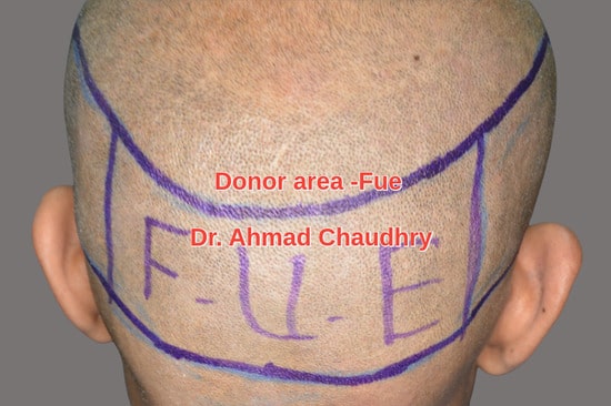 Fue hair transplant donor area Riyadh patient