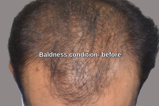 Male pattern baldness Riyadh patient