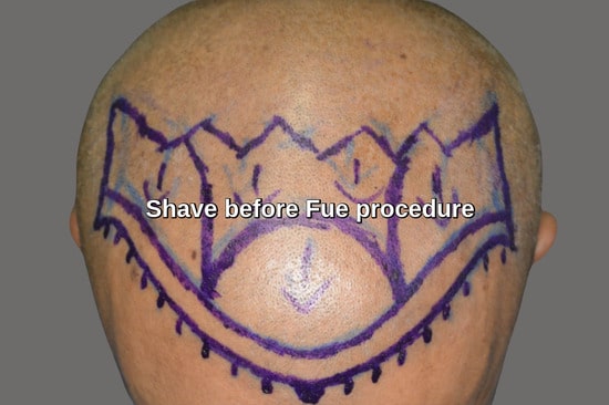 Shave before Fue procedure Saudi Arabia patient