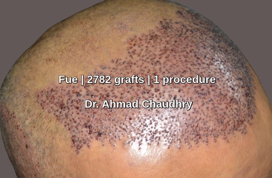 Side view- hair restoration Riyadh patient